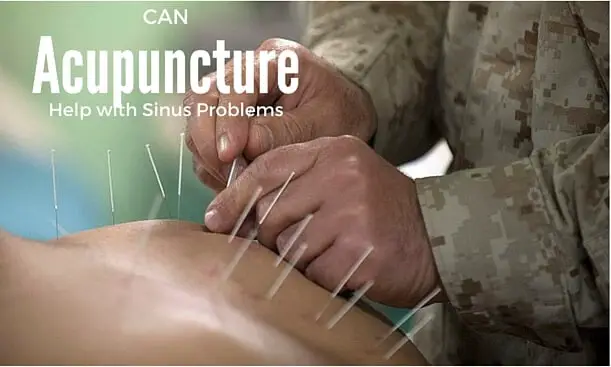 Can Acupuncture Help with Sinus Problems