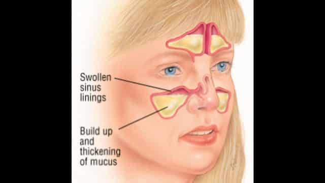 sinus problems and mucus
